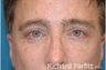 50 Year Old Male Treated for Sagging 'Sad' Eyes