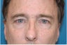 50 Year Old Male Treated for Sagging 'Sad' Eyes