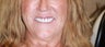 All-on-4 Dental Implants