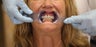 All-on-4 Dental Implants