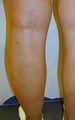Patient treated for blue bulging varicose veins of the legs