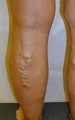 Patient treated for blue bulging varicose veins of the legs