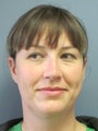 Chin Augmentation on 32-year-old