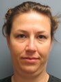 Chin Augmentation on 32-year-old