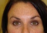 forehead lines