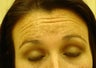 forehead lines