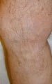 Varicose Vein Treatment Legs