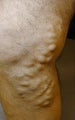 Varicose Vein Treatment Legs