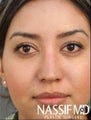 Hispanic Female Rhinoplasty