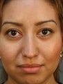 Hispanic Female Rhinoplasty
