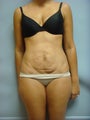 Tummy Tuck