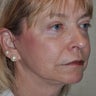 63 Year-Old Female Treated For Facial Wrinkles and Pigmentation Issues