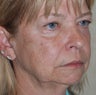 63 Year-Old Female Treated For Facial Wrinkles and Pigmentation Issues