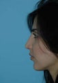 External "open" Rhinoplasty