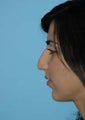 External "open" Rhinoplasty