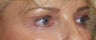 Aging brow and lower lids