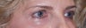 Aging brow and lower lids