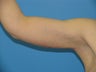 40 yr old woman with an arm lift