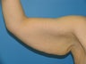 40 yr old woman with an arm lift