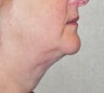 52 Year-Old Female Treated For A Fat Neck
