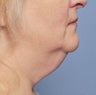 52 Year-Old Female Treated For A Fat Neck