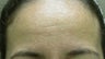 47 Year Old Woman Treated for Forehead Aging