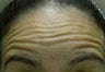 47 Year Old Woman Treated for Forehead Aging