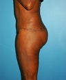 body lift with buttock lift
