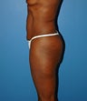 body lift with buttock lift