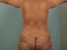 Liposuction