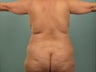 Liposuction
