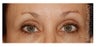 Eye Area Rejuvenation