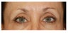 Eye Area Rejuvenation