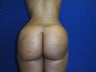 37 year old Brazilian Butt Lift