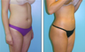 Liposuction Before & After