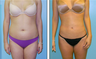 Liposuction Before & After