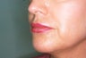 Restylane