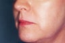 Restylane