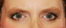 Browlift