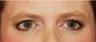 Browlift