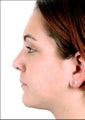 Rhinoplasty