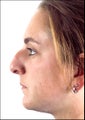 Rhinoplasty