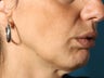Radiesse filler for jowls and nasolabial folds (liquid facelift)