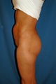 35 year old female Brazilian Butt Lift
