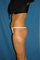 35 year old female Brazilian Butt Lift