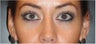 Restylane