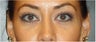 Restylane