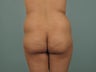 Brazilian Butt Lift