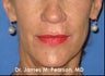 Injectable Filler Treatment