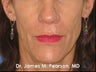 Injectable Filler Treatment